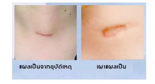 ✨ ทำไม “แผลเป็น” ถึงควรรักษาให้หาย และการดูแลที่ถูกต้องสำคัญแค่ไหน