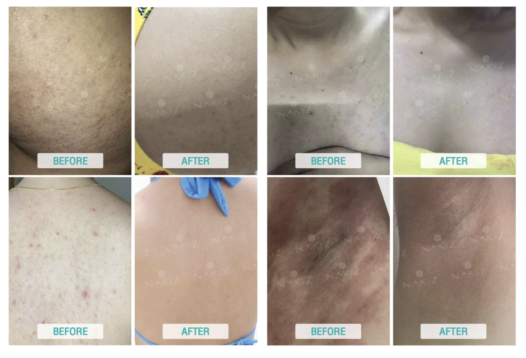 🌸 เปิดเผยปัญหารอยดำทั่วเรือนร่าง พร้อมเคล็ดลับผิวใสเนียนด้วย NAKIZ LIVELY BUTT & LIVELY SCRUB