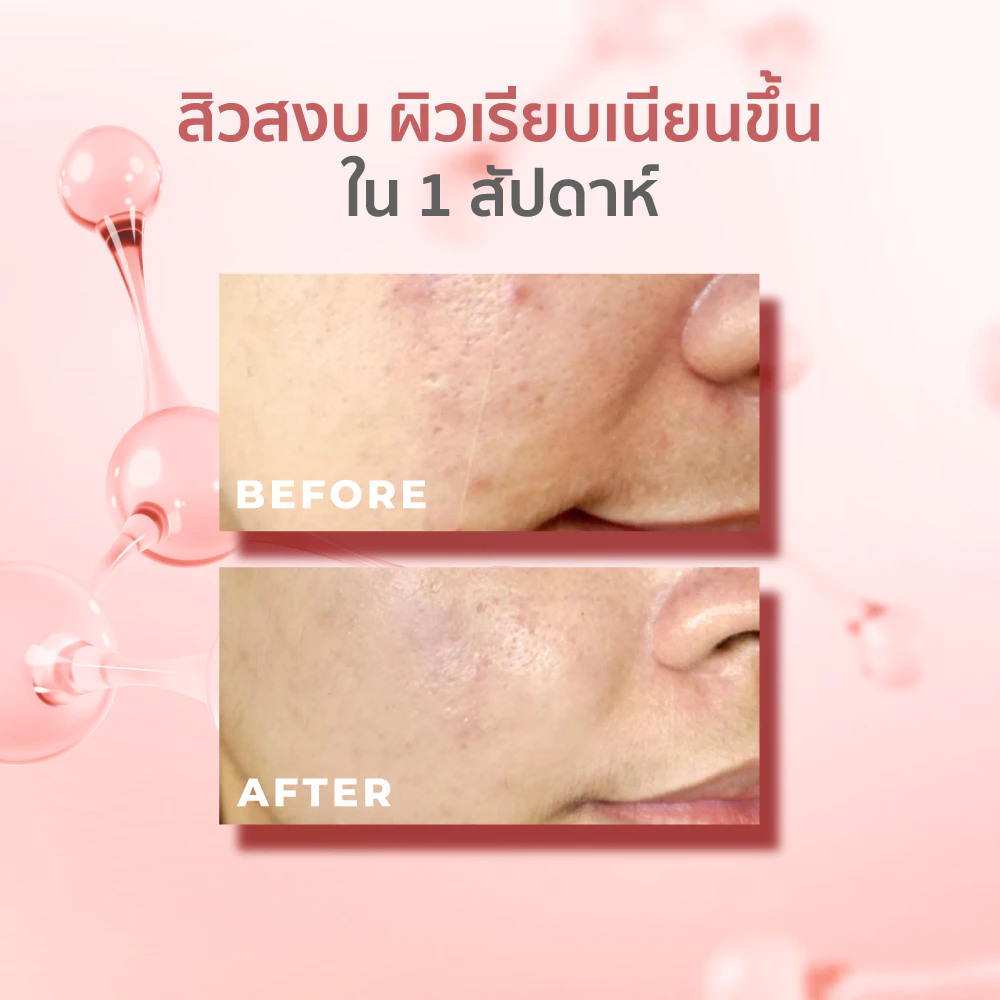 HER HYNESS Prebio Complete Anti-Acne Serum เซรั่มสิวสายอ่อนโยน เน้นบาลานซ์ผิวมากกว่าฆ่าสิวแรง Image6