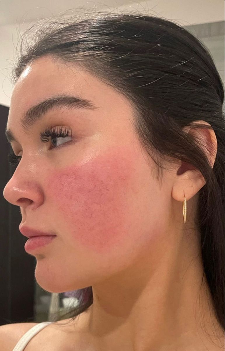 ผิวไหม้แดด…ไม่ใช่แค่แสบ แต่คือสัญญาณเตือนที่หลายคนมองข้าม Image3