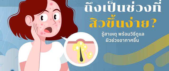 ทำไมสิวขึ้นหนักในหน้าฝน? เปิดสาเหตุพร้อมวิธีดูแลผิว