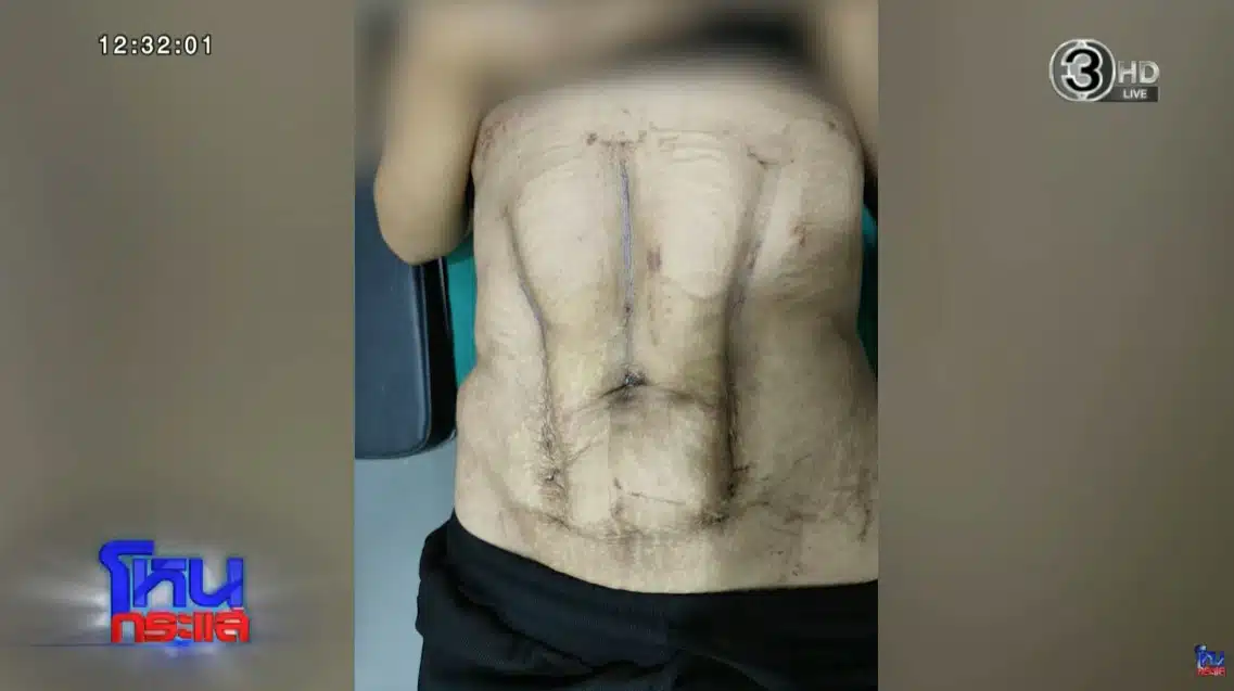 เมื่อศัลยกรรมเสริมความงามพลาด คู่มือเรียกร้องค่าเสียหายอย่างไม่ยอมถูกเอาเปรียบ