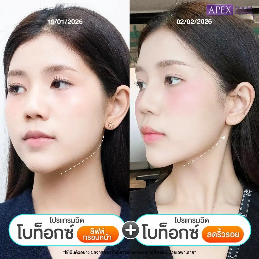 ผลข้างเคียงโบท็อก แยกอาการธรรมดาและสัญญาณอันตรายที่ต้องรู้