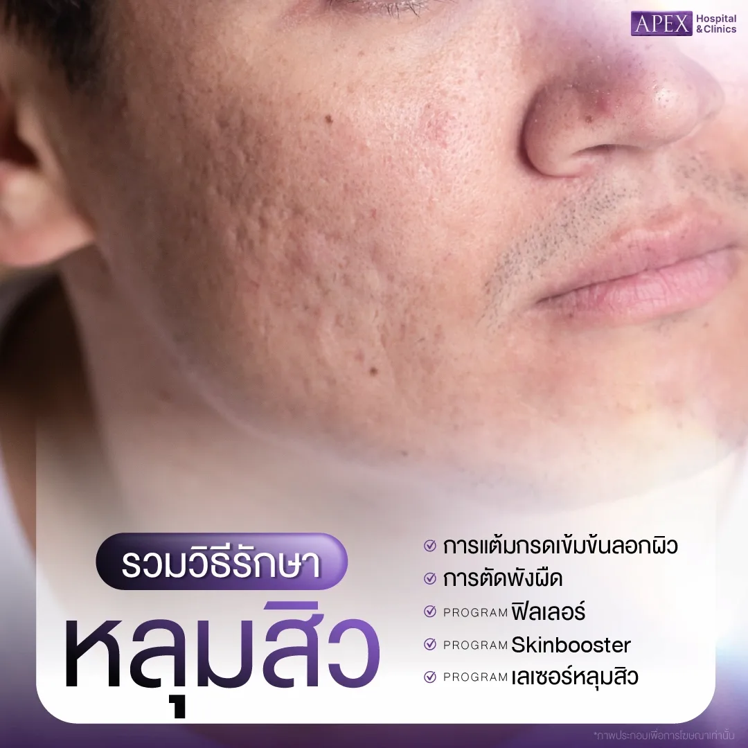 หลุมสิวและวิธีรักษา เลเซอร์ vs การรักษาด้วยตัวเอง