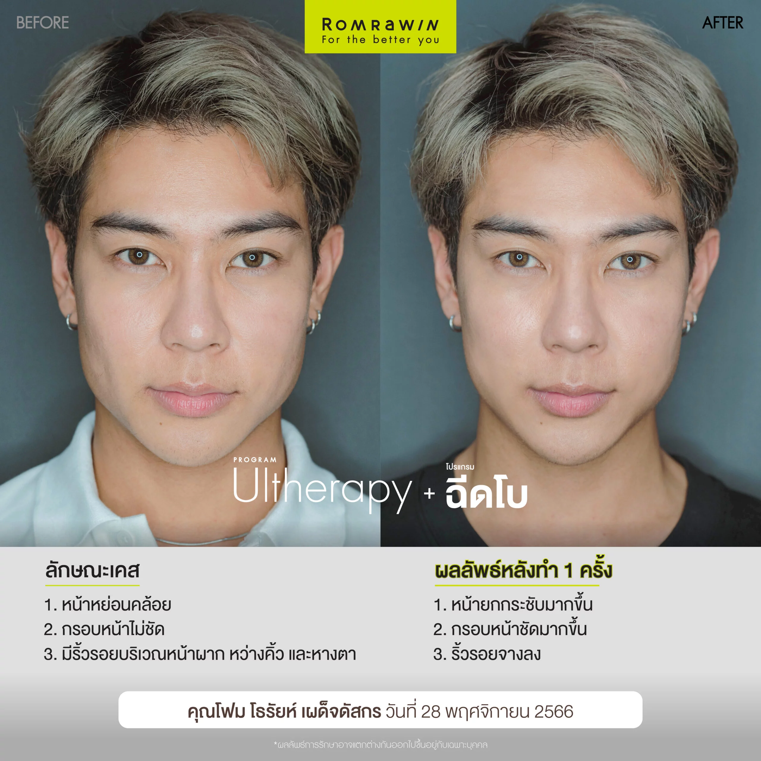 โบท็อกลิฟกรอบหน้า ยกกระชับกรอบหน้าให้เฟสไลน์ชัดโดยไม่ต้องผ่า