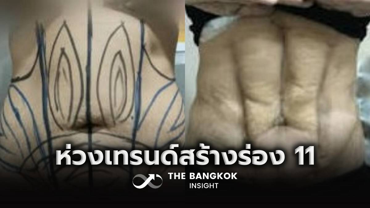ดูดไขมันสร้างร่อง 11: เมื่อความสวยชนมาตรฐานความปลอดภัยและสิทธิผู้บริโภค