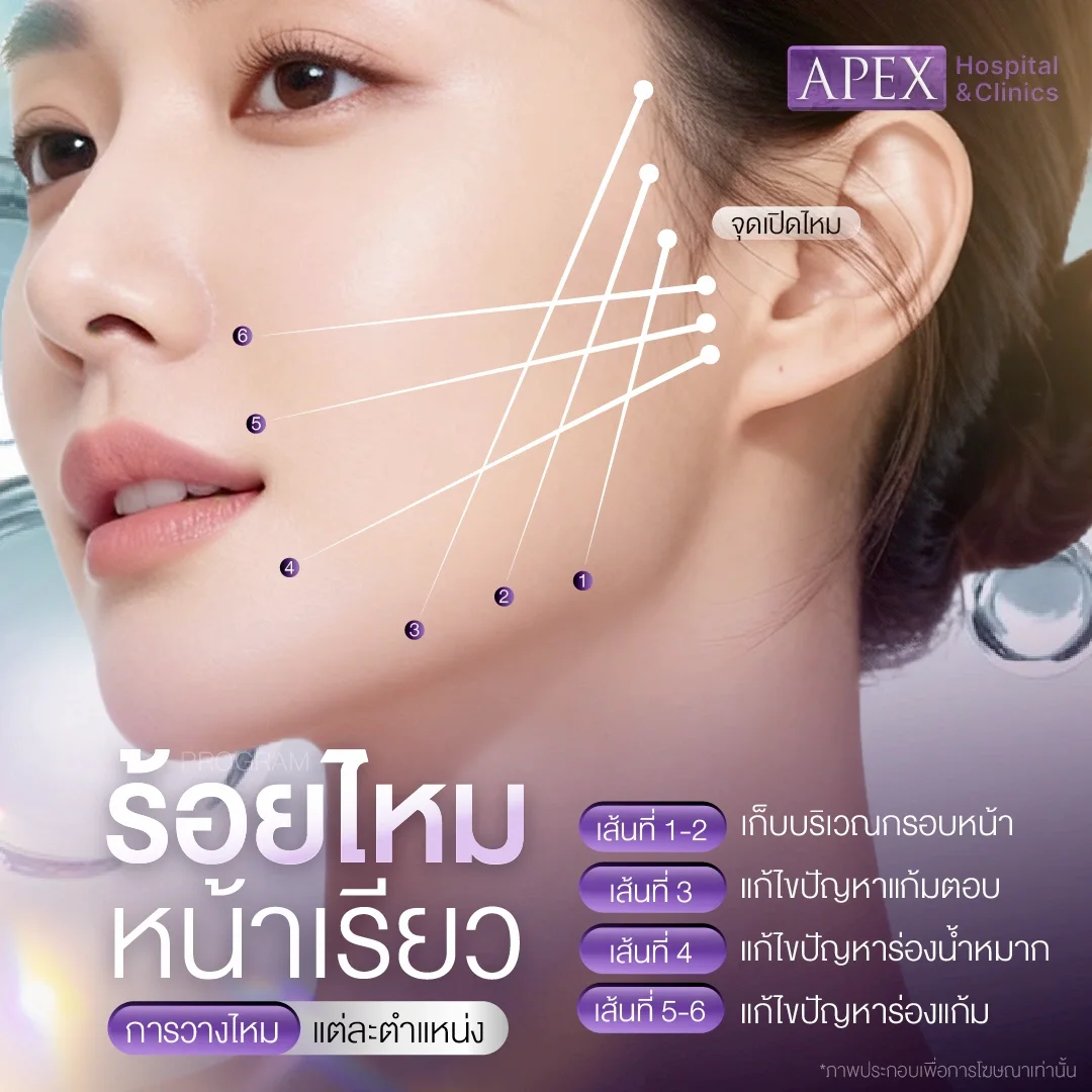 ร้อยไหม vs HIFU เลือกเทคนิคยกกระชับผิวหน้าแบบไหนให้เหมาะกับคุณ
