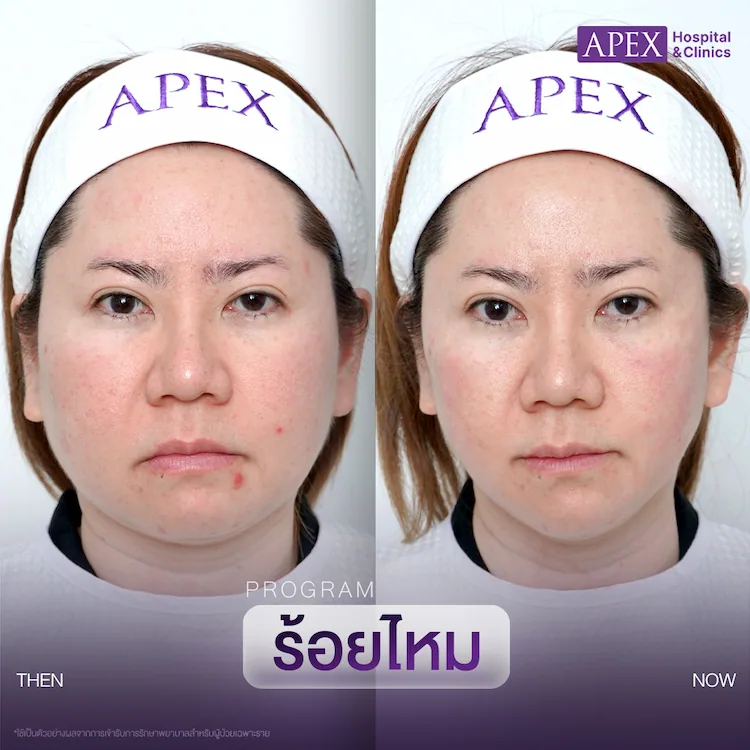 ร้อยไหม vs HIFU เลือกเทคนิคยกกระชับผิวหน้าแบบไหนให้เหมาะกับคุณ