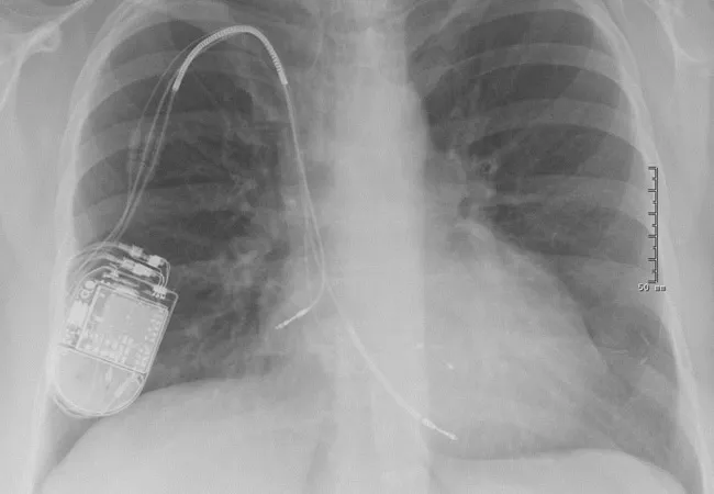 หมอเตือนภัย Smartwatch ECG เสี่ยงกวนเครื่องกระตุ้นหัวใจ