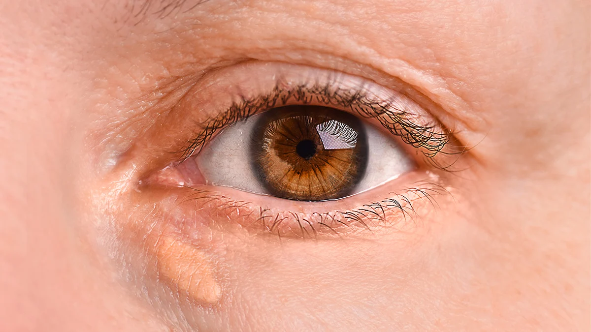 6 โรคหัวใจเงียบที่เล่นงานไม่ทันตั้งตัว สัญญาณบนหน้าและจังหวะหัวใจที่ไม่ควรเมิน