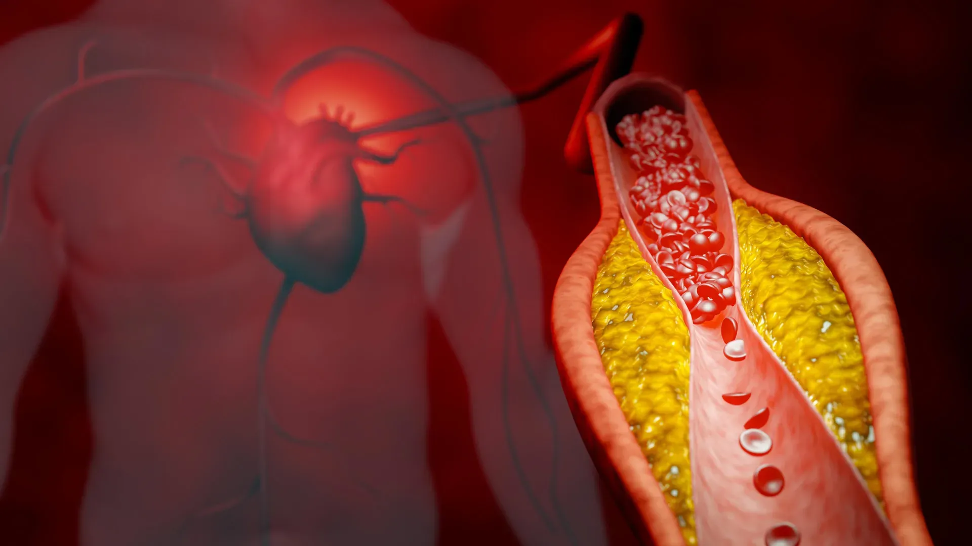 ยา DNA ลดคอเลสเตอรอล ที่เล็งเป้า PCSK9 ทางเลือกแทนสแตตินกำลังก่อรูป