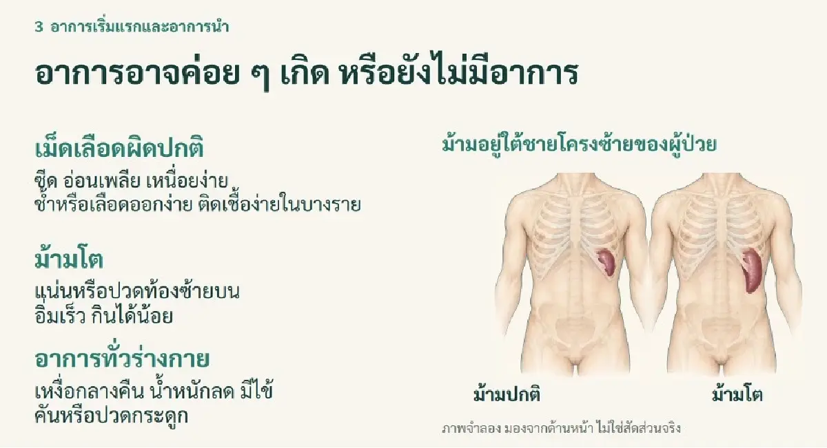 3 อาการเล็กที่ไม่เล็ก เหนื่อย ซีด แน่นท้อง สัญญาณเตือนโรค MF มะเร็งโลหิตหายาก