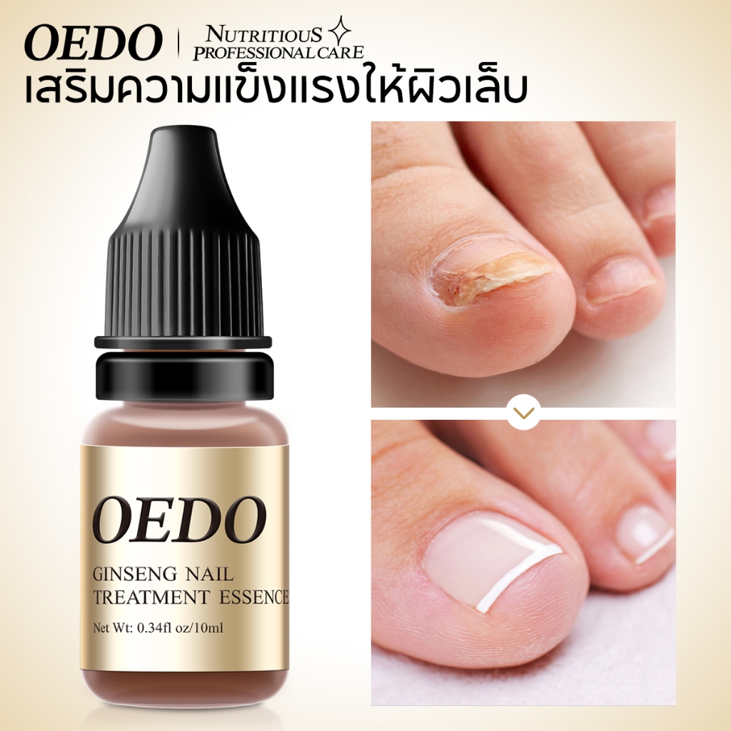 ราคาลดลงใหม่: OEDO รักษาเชื้อราเล็บ
