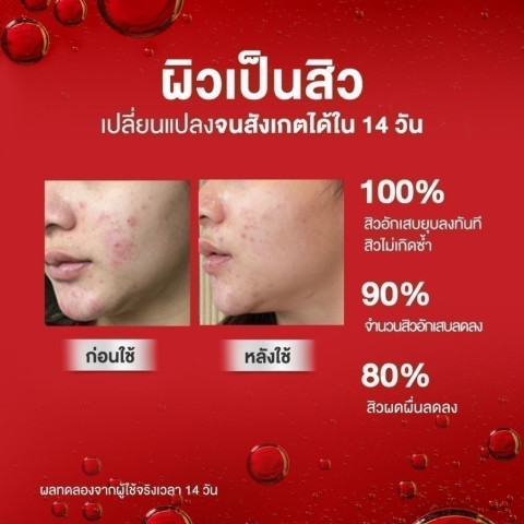Skinsista Perfect Clear Anti-Acne Booster บูสเตอร์เซรั่มเคลียร์ทุกปัญหาสิวในขวดเดียว 20ml. Image6