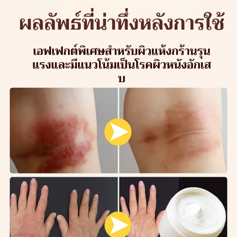 🔥 BaiYaoLang ครีมลดอาการคัน🔥ครีมแก้คัน 20g ใช้ทาได้ทุกตำแหน่งของร่างกาย รวมทั้งจุดที่บอบบาง เช่น ใบหน้า ขาหนีบ ออร์แกนิค Image4