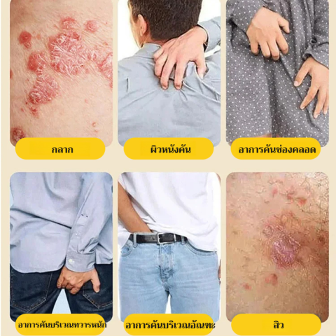 🔥 BaiYaoLang ครีมลดอาการคัน🔥ครีมแก้คัน 20g ใช้ทาได้ทุกตำแหน่งของร่างกาย รวมทั้งจุดที่บอบบาง เช่น ใบหน้า ขาหนีบ ออร์แกนิค Image2