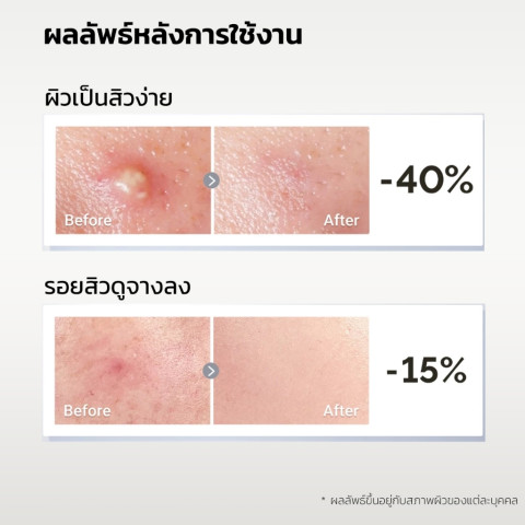 ICELERSKIN 24H Acne Serum 10ml เซรั่มแต้มสิว ลดสิวอักเสบ ลดรอยสิว ผิวเรียบเนียนขึ้น ซื้อ 1 แถม 1 ส่งฟรี Image2