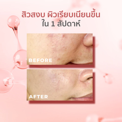 HER HYNESS PREBIO COMPLETE ANTI-ACNE SERUM 30 ML เฮอ ไฮเนส แอคเน่เซรั่ม 30 มล. Image6